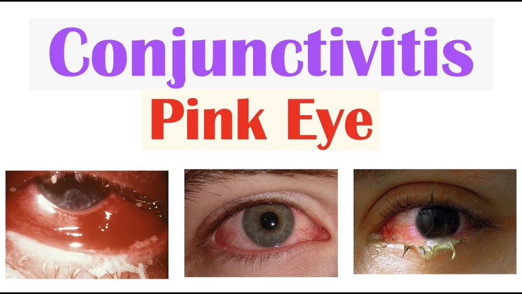Pink Eye (Conjunctivitis) Causes, Symptoms and Treatment