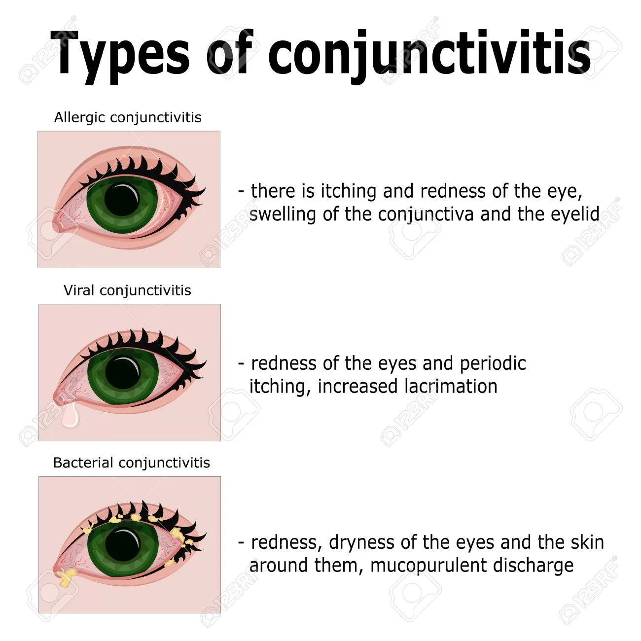 Types of Pink Eye