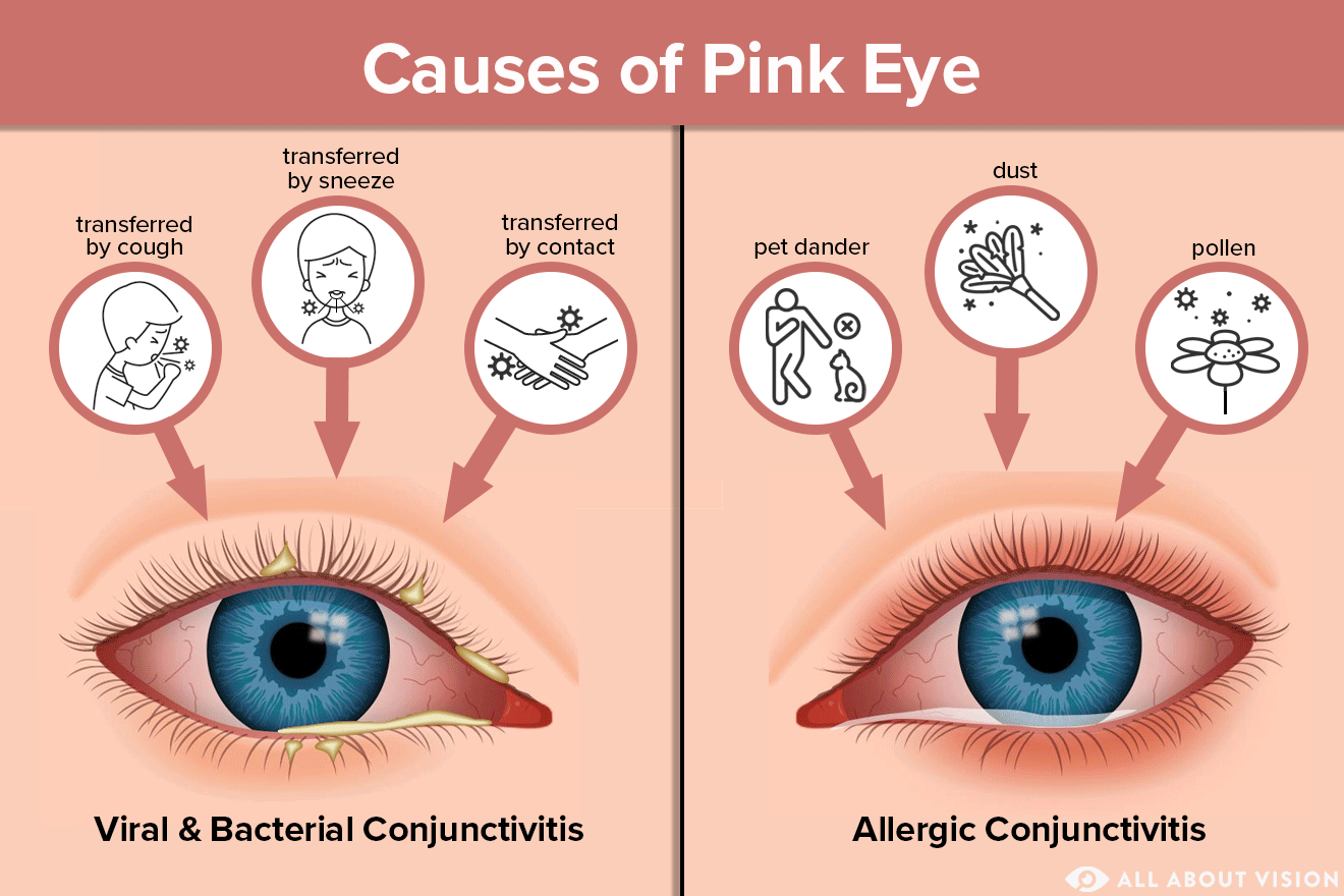 pink eye causes