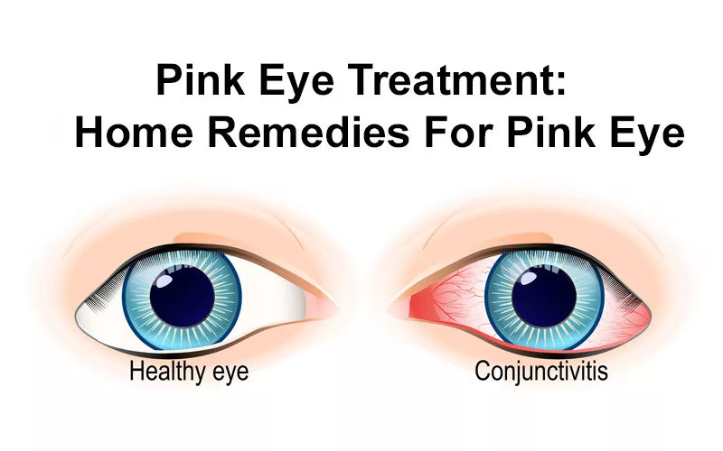 Pink Eye Treatment