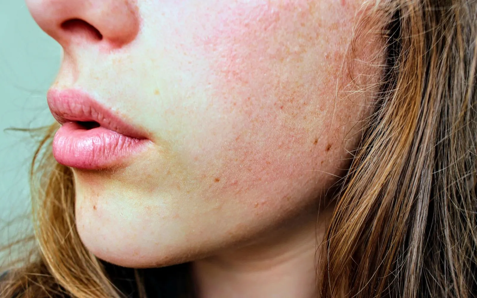 Close up of red, irritated skin on a woman’s cheek